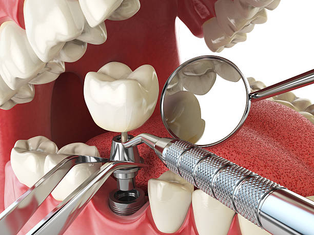 Best Emergency Dental Care for Broken or Chipped Teeth in Silver Lakes, CA