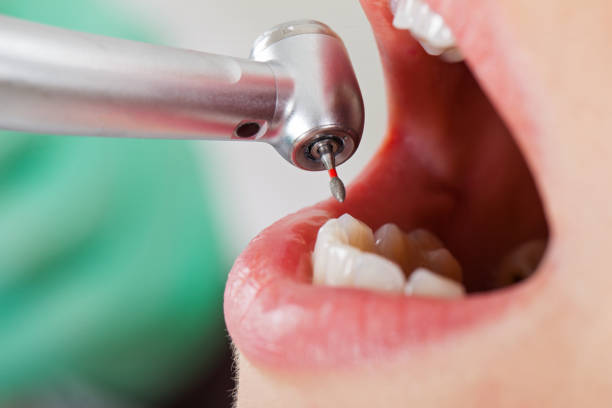 Best Emergency Treatment for Dental Infections or Abscesses in Silver Lakes, CA